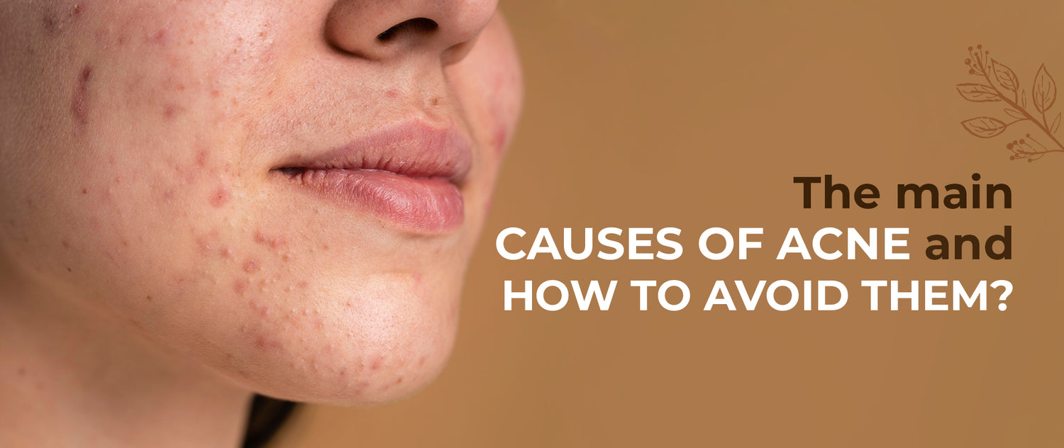 What are the main causes of acne and how to avoid them?