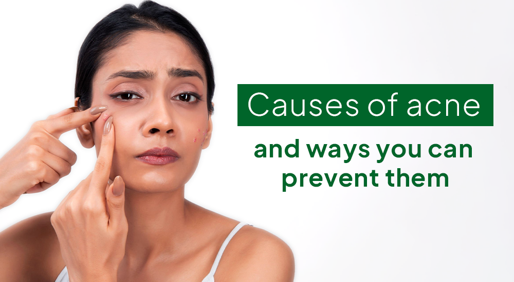 What is the main reason for acne and how to prevent acne naturally?